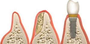 bone regeneration implantes dentales