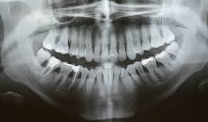 panoramica implante dental